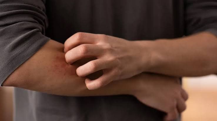 Aumento dei casi di dermatofilosi in Europa: Pregliasco rassicura sul basso rischio ma avverte sui cambiamenti nei contagi